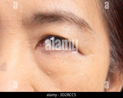 Pelle flaccida e rugosa sul viso di una donna anziana. Foto Stock