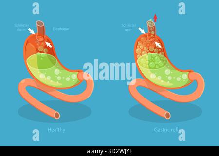 3D Isometric Flat Conceptual Illustration of stomach reflusso, digestive System problems 3D Isometric Flat Conceptual Illustration of stomach reflusso, digestive System problems Foto Stock