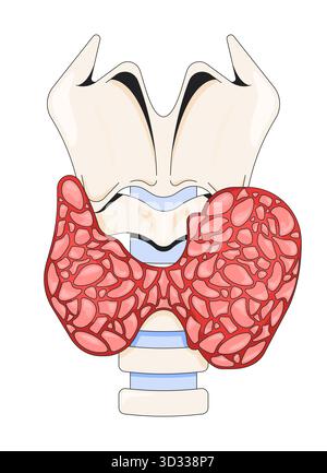 Ghiandola tiroidea ingrandita influenzata dall'illustrazione vettoriale 2D dell'ipertiroidismo Illustrazione Vettoriale