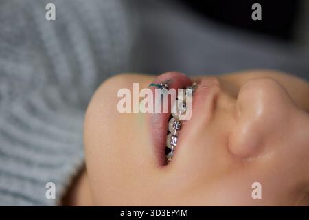 sorridi o frenulum che piergono sotto il labbro superiore. Foto Stock