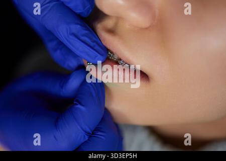 sorridi o frenulum che piergono sotto il labbro superiore. Foto Stock
