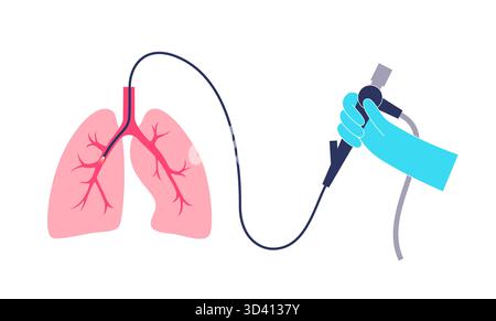 Illustrazione di una procedura broncoscopica. Ciò comporta l'inserimento di un tubo lungo, sottile e flessibile chiamato broncoscopio attraverso il naso o la bocca per esaminare il tubo del vento e le vie aeree. Viene utilizzato per diagnosticare le condizioni polmonari fornendo una visione chiara del rivestimento polmonare e consentire il prelievo di campioni di tessuto o fluido per analisi di laboratorio. Foto Stock
