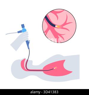 Illustrazione di una procedura broncoscopica. Ciò comporta l'inserimento di un tubo lungo, sottile e flessibile chiamato broncoscopio attraverso il naso o la bocca per esaminare il tubo del vento e le vie aeree. Viene utilizzato per diagnosticare le condizioni polmonari fornendo una visione chiara del rivestimento polmonare e consentire il prelievo di campioni di tessuto o fluido per analisi di laboratorio. Foto Stock
