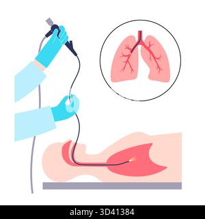 Illustrazione di una procedura broncoscopica. Ciò comporta l'inserimento di un tubo lungo, sottile e flessibile chiamato broncoscopio attraverso il naso o la bocca per esaminare il tubo del vento e le vie aeree. Viene utilizzato per diagnosticare le condizioni polmonari fornendo una visione chiara del rivestimento polmonare e consentire il prelievo di campioni di tessuto o fluido per analisi di laboratorio. Foto Stock