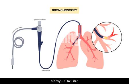 Illustrazione di una procedura broncoscopica. Ciò comporta l'inserimento di un tubo lungo, sottile e flessibile chiamato broncoscopio attraverso il naso o la bocca per esaminare il tubo del vento e le vie aeree. Viene utilizzato per diagnosticare le condizioni polmonari fornendo una visione chiara del rivestimento polmonare e consentire il prelievo di campioni di tessuto o fluido per analisi di laboratorio. Foto Stock