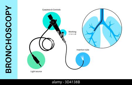 Illustrazione di una procedura broncoscopica. Ciò comporta l'inserimento di un tubo lungo, sottile e flessibile chiamato broncoscopio attraverso il naso o la bocca per esaminare il tubo del vento e le vie aeree. Viene utilizzato per diagnosticare le condizioni polmonari fornendo una visione chiara del rivestimento polmonare e consentire il prelievo di campioni di tessuto o fluido per analisi di laboratorio. Foto Stock