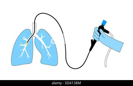 Illustrazione di una procedura broncoscopica. Ciò comporta l'inserimento di un tubo lungo, sottile e flessibile chiamato broncoscopio attraverso il naso o la bocca per esaminare il tubo del vento e le vie aeree. Viene utilizzato per diagnosticare le condizioni polmonari fornendo una visione chiara del rivestimento polmonare e consentire il prelievo di campioni di tessuto o fluido per analisi di laboratorio. Foto Stock