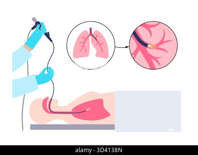 Illustrazione di una procedura broncoscopica. Ciò comporta l'inserimento di un tubo lungo, sottile e flessibile chiamato broncoscopio attraverso il naso o la bocca per esaminare il tubo del vento e le vie aeree. Viene utilizzato per diagnosticare le condizioni polmonari fornendo una visione chiara del rivestimento polmonare e consentire il prelievo di campioni di tessuto o fluido per analisi di laboratorio. Foto Stock