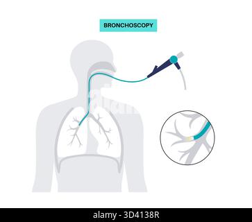 Illustrazione di una procedura broncoscopica. Ciò comporta l'inserimento di un tubo lungo, sottile e flessibile chiamato broncoscopio attraverso il naso o la bocca per esaminare il tubo del vento e le vie aeree. Viene utilizzato per diagnosticare le condizioni polmonari fornendo una visione chiara del rivestimento polmonare e consentire il prelievo di campioni di tessuto o fluido per analisi di laboratorio. Foto Stock