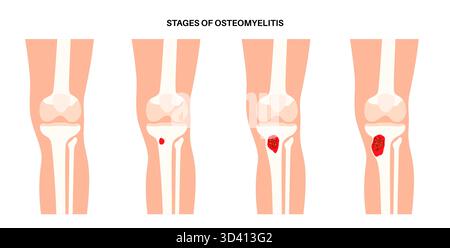 Illustrazione dell'osteomielite ossea della tibia. Si tratta di un'infezione dell'osso tibiale, comunemente causata dai batteri Staphylococcus aureus. Foto Stock