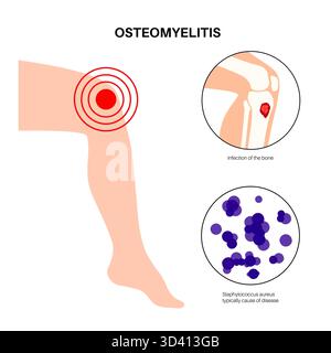 Illustrazione dell'osteomielite ossea della tibia. Si tratta di un'infezione dell'osso tibiale, comunemente causata dai batteri Staphylococcus aureus. Foto Stock