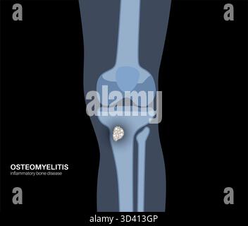 Illustrazione dell'osteomielite ossea della tibia. Si tratta di un'infezione dell'osso tibiale, comunemente causata dai batteri Staphylococcus aureus. Foto Stock