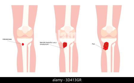 Illustrazione dell'osteomielite ossea della tibia. Si tratta di un'infezione dell'osso tibiale, comunemente causata dai batteri Staphylococcus aureus. Foto Stock