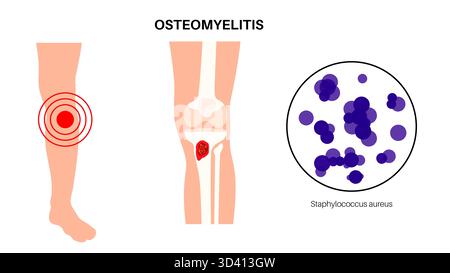 Illustrazione dell'osteomielite ossea della tibia. Si tratta di un'infezione dell'osso tibiale, comunemente causata dai batteri Staphylococcus aureus. Foto Stock