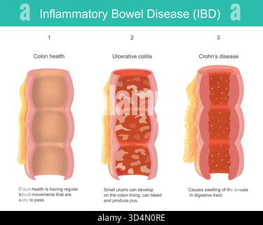 Malattia infiammatoria intestinale (IBD). Questo diagramma illustra le differenze tra un colon sano e i due principali tipi di Diseas intestinale infiammatorio Illustrazione Vettoriale