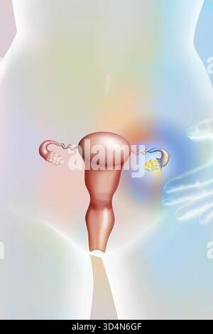 Illustrazione delle patologie delle tubature ovariche e di Falloppio: Cisti, cancro, oforite, ostruzione delle tubature, ecc. Cisti ovarica 016240 283 Foto Stock