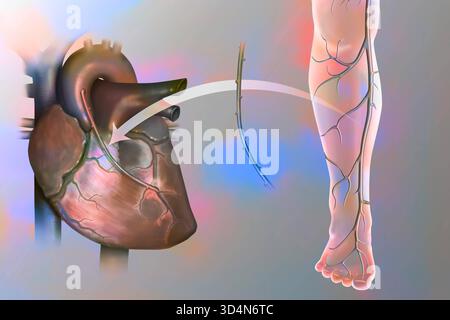 Innesto di bypass coronarico. L'ostruzione di un vaso coronarico da una placca ateromatosa viene compensata dal posizionamento di un bypass. Una parte Foto Stock