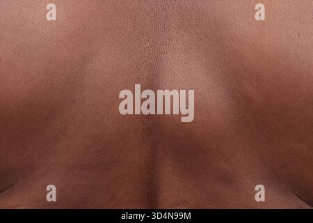 Lipoma della schiena in una donna di 65 anni. Foto Stock