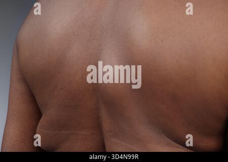 Lipoma della schiena in una donna di 65 anni. Foto Stock