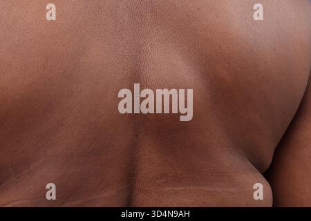 Lipoma della schiena in una donna di 65 anni. Foto Stock