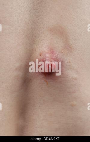 Cisti sebacea infetta sulla schiena di una donna di 59 anni. Foto Stock