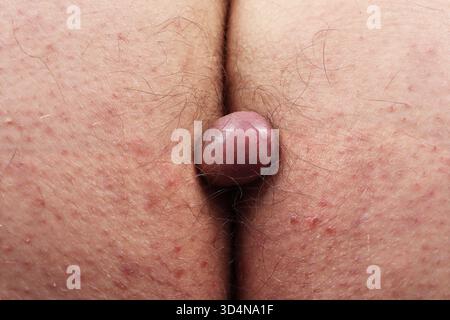 Cisti di Trichilemmal della nata in un uomo di 45 anni. Foto Stock