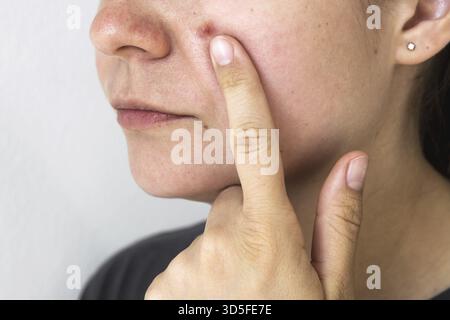 Donna che tocca un brufolo infiammato sulla guancia, mostrando imperfezioni cutanee e problemi di acne. Primo piano della pelle del viso con rossore e imperfezioni, alto Foto Stock