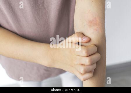 Un bambino che gratta un'eruzione cutanea rossa irritata sul braccio, mostrando sintomi di dermatite atopica. Il primo piano mette in evidenza il disagio e asciutto, infiammato Foto Stock