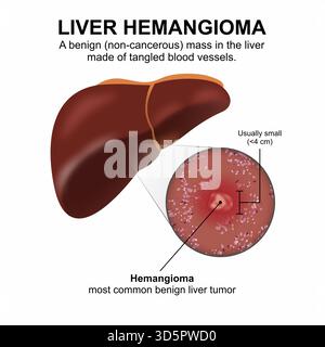 Emangioma epatico - tumore epatico benigno più comune Foto Stock