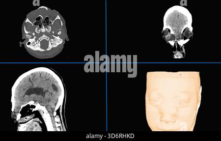 Scansioni di tomografia computerizzata cranica (TC) da un paziente con meningocele, che mostrano le viste assiale (in alto a destra), sagittale (in basso a destra) e coronale (in alto a sinistra). Un rendering 3D che utilizza le scansioni TC viene visualizzato in basso a sinistra. Il meningocele è una condizione in cui le membrane protettive (meningi) intorno al cervello sporgono attraverso un'apertura nel cranio. Il trattamento spesso comporta la riparazione chirurgica per prevenire complicazioni come l'infezione. Foto Stock