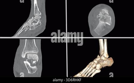 Tomografia computerizzata (TC) scansione di una frattura della caviglia dell'osso del talco, una delle ossa che compongono l'articolazione della caviglia. Le scansioni visualizzano le viste sagittale (in alto a sinistra), assiale (in alto a destra) e coronale (in basso a sinistra), con una ricostruzione 3D della caviglia mostrata in basso a destra. Foto Stock