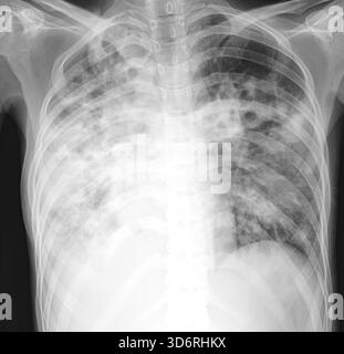 Radiografia dei polmoni di un paziente con tubercolosi polmonare. La tubercolosi polmonare è causata dal batterio Mycobacterium tuberculosis, che si diffonde per tosse e starnuti. I batteri creano tubercoli primari, lesioni nodulari dei polmoni. I sintomi includono febbre, perdita di peso e tosse di sangue. Il trattamento è con antibiotici a lungo termine. Foto Stock
