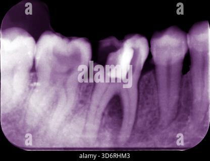 Raggi X periapicali colorati che mostrano un dente di saggezza influenzato e carie (carie dei denti). Un dente di saggezza influenzato è un terzo molare che non ha eruttato completamente, spesso perché non c'è abbastanza spazio. Ciò rende l'area difficile da pulire, consentendo a cibo e batteri di rimanere intrappolati e aumentando il rischio di gonfiore e decadimento dei denti. Il trattamento può includere la rimozione della parte decaduta del dente, l'inserimento di un riempimento, se possibile, o l'estrazione del dente saggezza interessato per prevenire problemi futuri. Foto Stock