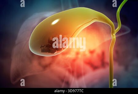 Cistifellea con pietra. illustrazione 3d. Foto Stock