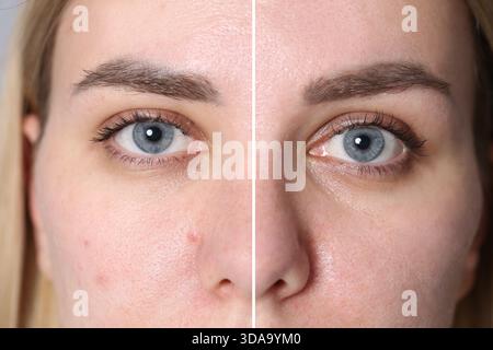 Donna che mostra la sua pelle prima e dopo il trattamento cosmetico, primo piano. Collage Foto Stock