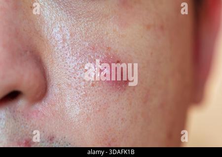 Primo piano dell'uomo asiatico con acne infiammata e cicatrice scura sulla guancia Foto Stock