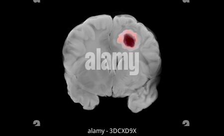 Vista coronale di un cervello umano in scala di grigi che mostra un tumore glioblastoma sotto forma di massa marrone scura con un alone rosa nell'emisfero cerebrale sinistro contro Foto Stock