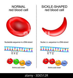 Anemia falciforme. Globuli rossi normali e globuli rossi a forma di falce. Primo piano della catena amminoacidica e della sequenza nucleotidica in un filamento di DNA. Immagine vettoriale Illustrazione Vettoriale
