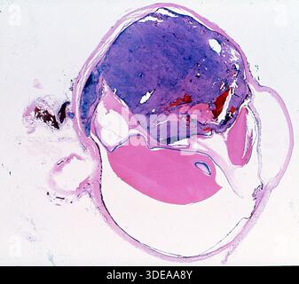 Melanoma maligno uveale, cancro oculare, al microscopio Foto Stock