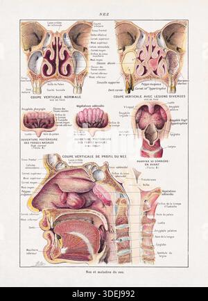 Illustrazione medica a colori di Adolphe Philippe Millot sul tema del naso e delle sue malattie. Foto Stock