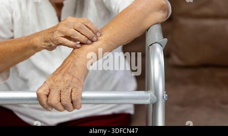 Donna anziana prurito e graffiare il braccio perché la pelle è secca. Foto Stock