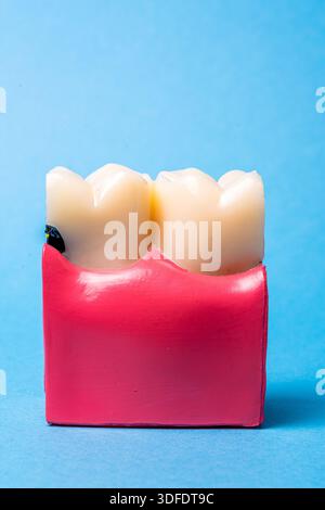 Modello dentale che mostra decadimento e malattie gengivali Foto Stock