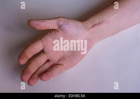 Foto ravvicinata di una cicatrice chirurgica guarita su un polso umano. Concetto medico che mostra il recupero dopo l'intervento chirurgico, il trattamento delle lesioni, l'assistenza sanitaria e il rehabilit Foto Stock
