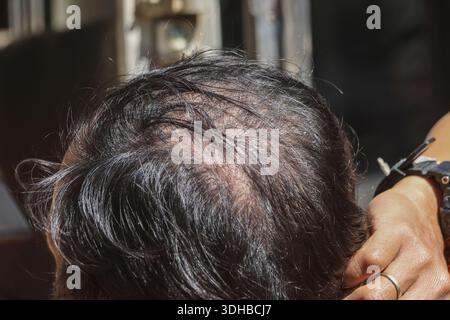 Vista dall'alto ravvicinata della testa maschile che mostra un grave problema di perdita dei capelli con diradamento del cuoio capelluto e problemi di alopecia areata che causano preoccupazione e ansia Foto Stock