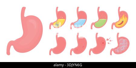 Insieme vettoriale di stomaco umano con diverse condizioni di salute. Illustrazione Vettoriale