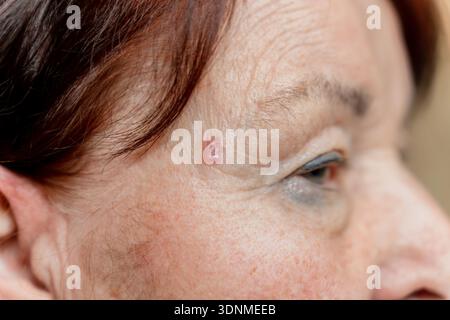 Carcinoma a cellule basali sul tempio di una donna anziana. San Pietroburgo, Russia - 17 gennaio 2026 Foto Stock