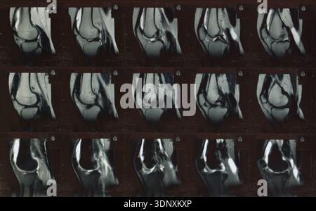 Scansione RM che mostra immagini di sezioni trasversali multiple dell'articolazione del ginocchio in pellicole radiologiche. Concetto di diagnostica medica, tecnologia di imaging RM, ortopedico Foto Stock
