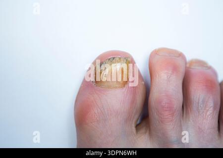 Unghia di recupero con infezione fungina che viene trattata con lacca medicata Amorolfine 5% per unghie; trattamento antimicotico applicato localmente. (147) Foto Stock