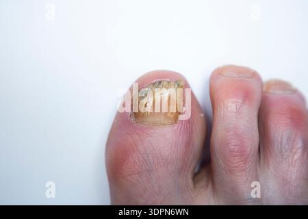 Unghia di recupero con infezione fungina che viene trattata con lacca medicata Amorolfine 5% per unghie; trattamento antimicotico applicato localmente. (147) Foto Stock