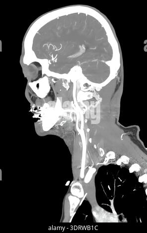 Scansione TC della testa umana che mostra il cervello e il sistema vascolare di un paziente maschio sano di 72 anni Foto Stock